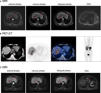 Case Report: Primary hepatic neuroendocrine tumor: two cases report with literature review